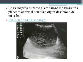 • Una ecografía durante el embarazo mostrará una
placenta anormal con o sin algún desarrollo de
un bebé
• Examen de GCH en sangre
 