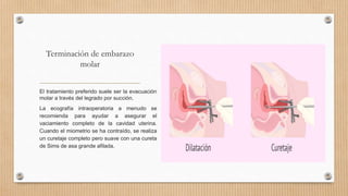 Terminación de embarazo
molar
El tratamiento preferido suele ser la evacuación
molar a través del legrado por succión.
La ecografía intraoperatoria a menudo se
recomienda para ayudar a asegurar el
vaciamiento completo de la cavidad uterina.
Cuando el miometrio se ha contraído, se realiza
un curetaje completo pero suave con una cureta
de Sims de asa grande afilada.
 