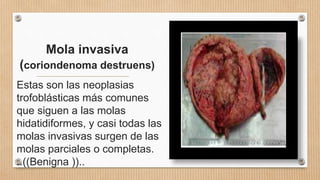 Mola invasiva
(coriondenoma destruens)
Estas son las neoplasias
trofoblásticas más comunes
que siguen a las molas
hidatidiformes, y casi todas las
molas invasivas surgen de las
molas parciales o completas.
..((Benigna ))..
 