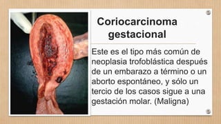 Coriocarcinoma
gestacional
Este es el tipo más común de
neoplasia trofoblástica después
de un embarazo a término o un
aborto espontáneo, y sólo un
tercio de los casos sigue a una
gestación molar. (Maligna)
 
