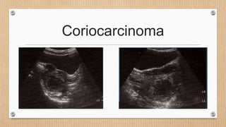 Coriocarcinoma
 