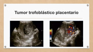 Tumor trofoblástico placentario
 