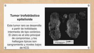 Tumor trofoblástico
epitelioide
Este tumor raro se desarrolla
a partir de trofoblasto
intermedio de tipo coriónico.
El útero es el sitio principal
de compromiso, y los
hallazgos típicos son
sangramiento y niveles bajos
de hCG
 