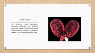 Clasificación
Mola completa: tiene vellosidades
coriónicas anormales que aparecen
como una masa de vesículas claras.
Éstas varían en tamaño y, a menudo,
cuelgan en grupos de pedículos finos.
.
 