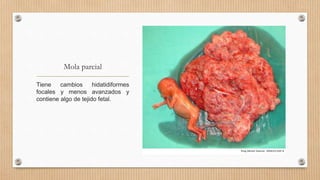 Mola parcial
Tiene cambios hidatidiformes
focales y menos avanzados y
contiene algo de tejido fetal.
 