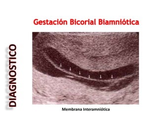 Membrana Interamniótica
 