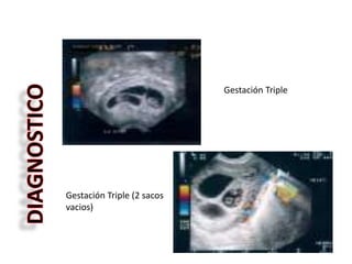 Gestación Triple
Gestación Triple (2 sacos
vacios)
 