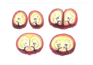 Sacos gestacionales




 Bi-vitelino.   Uni-vitelino.    Uni-vitelino.
Bi-amniótico.   Bi-amniótico.   Uni-amniotico.
Bi-coriónico.   Bi-coriónico.    Bi-coriónico.
 