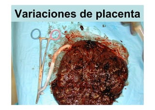 Variaciones de placenta
       Un oo                            Dos oo



Un Corion         Dos Corion              Dos Corion


Placenta    Placenta   Placenta    Placenta     Placenta
  única    Fusionada    Doble     Fusionada      Doble

 20%        6%           7%         30%             37%


            33%                               67%
 