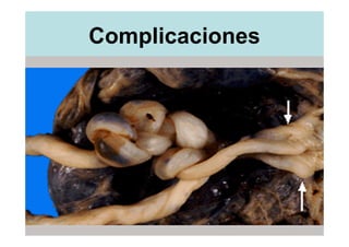 Complicaciones
 