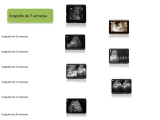 Ecografía de 7 semanas




Ecografía de 12 semanas




Ecografía de 13 semanas




Ecografía de 13 semanas




Ecografía de 17 semanas




Ecografía de 17 semanas




Ecografía de 20 semanas
 