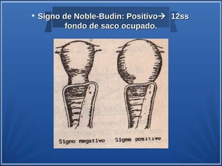 • Signo de Noble-Budin: Positivo 12ss
        fondo de saco ocupado.
 
