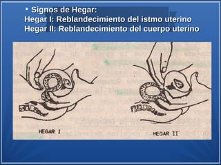 • Signos de Hegar:
Hegar I: Reblandecimiento del istmo uterino
Hegar II: Reblandecimiento del cuerpo uterino
 