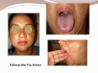 Valoración Vía Aérea