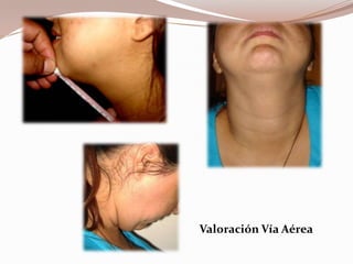Valoración Vía Aérea