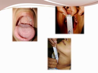 Embarazo  Y  Via  Aerea