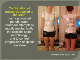 Combination of
pressures applied to
the torso
over a prolonged
period, brace
treatment attempts to
modify mechanically
the scoliotic spine
morphology
and to control
progression of spinal
curvature
Peterson et al, JBJS, 1995
 