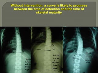 Without intervention, a curve is likely to progress
between the time of detection and the time of
skeletal maturity
 