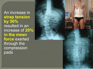 An increase in
strap tension
by 50%
resulted in an
increase of 20%
in the mean
force exerted
through the
compression
pads
 