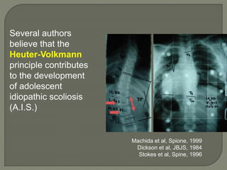 Several authors
believe that the
Heuter-Volkmann
principle contributes
to the development
of adolescent
idiopathic scoliosis
(A.I.S.)
Machida et al, Spione, 1999
Dickson et al, JBJS, 1984
Stokes et al, Spine, 1996
 