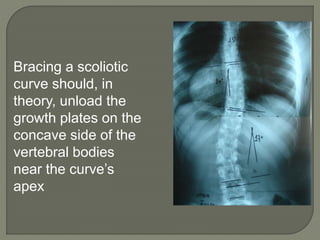 Bracing a scoliotic
curve should, in
theory, unload the
growth plates on the
concave side of the
vertebral bodies
near the curve’s
apex
 