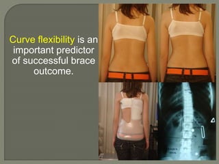 Curve flexibility is an
important predictor
of successful brace
outcome.
 