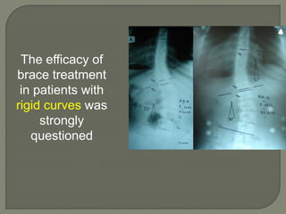 The efficacy of
brace treatment
in patients with
rigid curves was
strongly
questioned
 