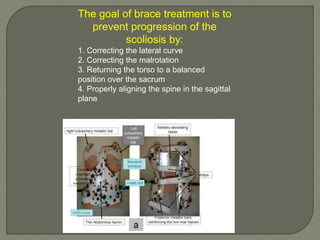 The goal of brace treatment is to
prevent progression of the
scoliosis by:
1. Correcting the lateral curve
2. Correcting the malrotation
3. Returning the torso to a balanced
position over the sacrum
4. Properly aligning the spine in the sagittal
plane
 