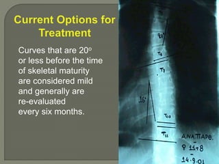 Curves that are 20o
or less before the time
of skeletal maturity
are considered mild
and generally are
re-evaluated
every six months.
 
