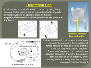 Derotation Pad
Axial rotation is most efficiently corrected by using force
couples, that is using a pair of forces directed in opposite
directions working on opposite sides of the axis
majority of derotational corrective forces are built-in to
the brace.
Just as the lateral forces require a relief area
opposite the correcting force, rotational
forces require an area of relief so that the
spine can migrate axially to derotate.
These relief areas can be created by an
adjacent pad which draws the brace away
from the body as seen anteriorly or by
bending the brace away from the body as
seen posteriorly on the right
Anterior Lumbar
Derotation Pad
 
