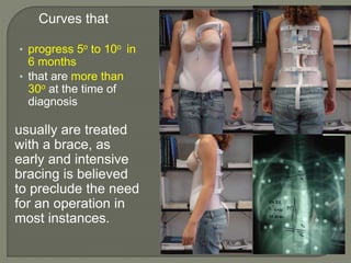 Curves that
• progress 5o to 10o in
6 months
• that are more than
30o at the time of
diagnosis
usually are treated
with a brace, as
early and intensive
bracing is believed
to preclude the need
for an operation in
most instances.
 
