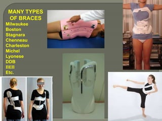 MANY TYPES
OF BRACES
Milwaukee
Boston
Stagnara
Chenneau
Charleston
Michel
Lyonese
DDB
ΠΕΠ
Etc.
 