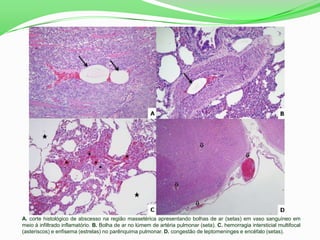 A. corte histológico de abscesso na região massetérica apresentando bolhas de ar (setas) em vaso sanguíneo em
meio à infiltrado inflamatório. B. Bolha de ar no lúmem de artéria pulmonar (seta). C. hemorragia intersticial multifocal
(asteriscos) e enfisema (estrelas) no parênquima pulmonar. D. congestão de leptomeninges e encéfalo (setas).
 