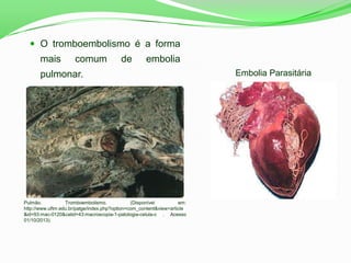  O tromboembolismo é a forma
mais comum de embolia
pulmonar.
Pulmão. Tromboembolismo. (Disponível em:
http://www.uftm.edu.br/patge/index.php?option=com_content&view=article
&id=93:mac-0120&catid=43:macroscopia-1-patologia-celula-c . Acesso
01/10/2013).
Embolia Parasitária
 