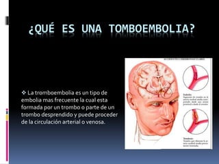 ¿QUÉ ES UNA TOMBOEMBOLIA? 
 La tromboembolia es un tipo de 
embolia mas frecuente la cual esta 
formada por un trombo o parte de un 
trombo desprendido y puede proceder 
de la circulación arterial o venosa. 
 