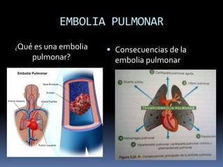 EMBOLIA PULMONAR 
 Consecuencias de la 
embolia pulmonar 
¿Qué es una embolia 
pulmonar? 
 