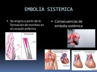 EMBOLIA SISTEMICA 
 Se origina a partir de la 
formación de trombos en 
el corazón enfermo 
 Consecuencias de 
embolia sistémica 
 