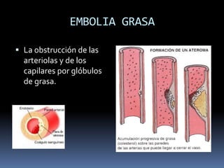 EMBOLIA GRASA 
 La obstrucción de las 
arteriolas y de los 
capilares por glóbulos 
de grasa. 
 