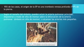 • 95% de los casos, el origen de la EP es una trombosis venosa profunda (TVP) de
la pierna.
• Según el tamaño del émbolo, pueden ocluir la arteria pulmonar principal,
disponerse a modo de silla de montar sobre la bifurcación de la arteria
pulmonar (émbolo en silla de montar) o alcanzar las arterias más pequeñas.
 