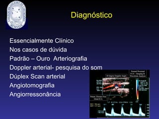 Diagnóstico
Essencialmente Clínico
Nos casos de dúvida
Padrão – Ouro Arteriografia
Doppler arterial- pesquisa do som
Dúplex Scan arterial
Angiotomografia
Angiorressonância
 