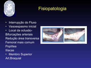 Fisiopatologia
• Interrupção do Fluxo
• Vasoespasmo inicial
• Local da oclusão-
Bifurcações arteriais
Redução área transversa
Femoral mais comum
Poplítea
Ilíacas
• Membro Superior
Art.Braquial
 