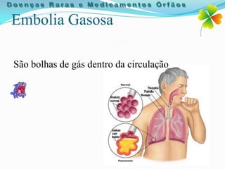 Embolia Gasosa

São bolhas de gás dentro da circulação
 