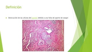 Definición 
 Destrucción de las células del pulmón debido a una falta de aporte de sangre 
