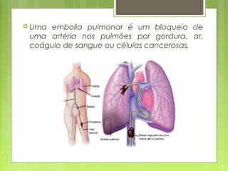  Uma embolia pulmonar é um bloqueio de
uma artéria nos pulmões por gordura, ar,
coágulo de sangue ou células cancerosas.​
 