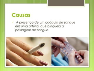 Causas
• A presença de um coágulo de sangue
em uma artéria, que bloqueia a
passagem de sangue.​
 