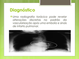 Diagnóstico
 Uma radiografia torácica pode revelar
alterações discretas no padrão da
vascularização após uma embolia e sinais
de infarto pulmonar.
 