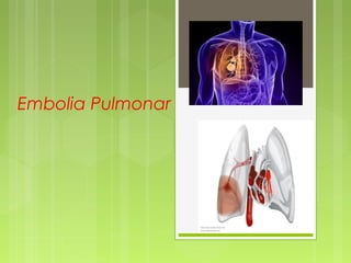 Embolia Pulmonar
  
 