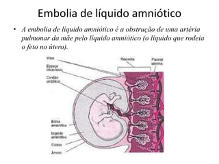 Embolia de líquido amniótico
• A embolia de líquido amniótico é a obstrução de uma artéria
pulmonar da mãe pelo líquido amniótico (o líquido que rodeia
o feto no útero).
 