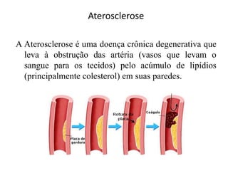 Aterosclerose
A Aterosclerose é uma doença crônica degenerativa que
leva à obstrução das artéria (vasos que levam o
sangue para os tecidos) pelo acúmulo de lipídios
(principalmente colesterol) em suas paredes.
 