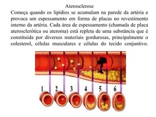 Aterosclerose
Começa quando os lipídios se acumulam na parede da artéria e
provoca um espessamento em forma de placas no revestimento
interno da artéria. Cada área de espessamento (chamada de placa
aterosclerótica ou ateroma) está repleta de uma substância que é
constituida por diversos materiais gordurosas, principalmente o
colesterol, células musculares e células do tecido conjuntivo.
 